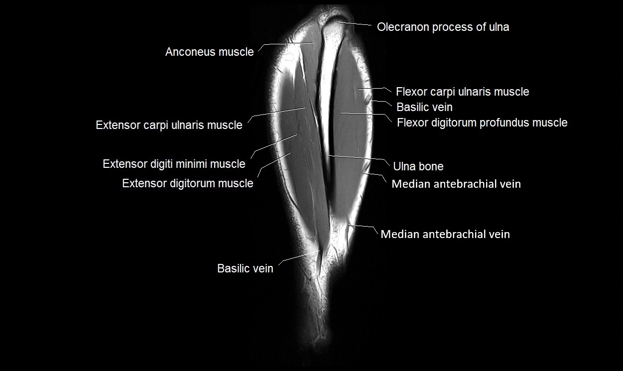 MRI 3T forearm coronal cross sectional anatomy image 24.webp